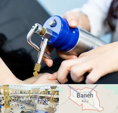 کرایوتراپی در بانه