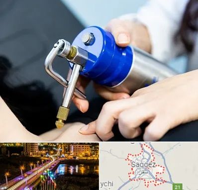 کرایوتراپی در سقز