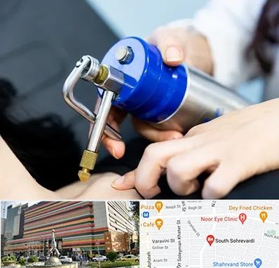 کرایوتراپی در سهروردی 