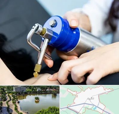 کرایوتراپی در لنگرود