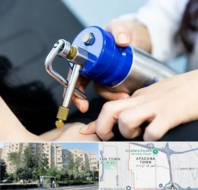 کرایوتراپی در آپادانا