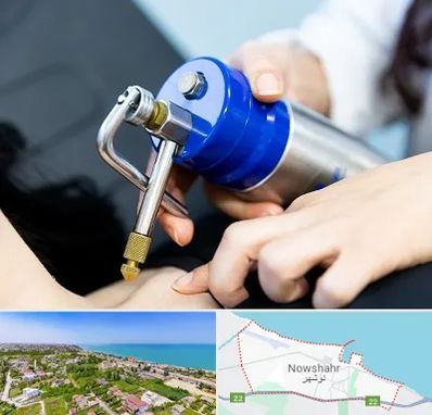 کرایوتراپی در نوشهر