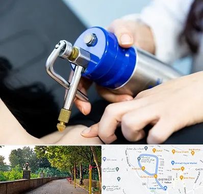 کرایوتراپی در فلکه گاز رشت