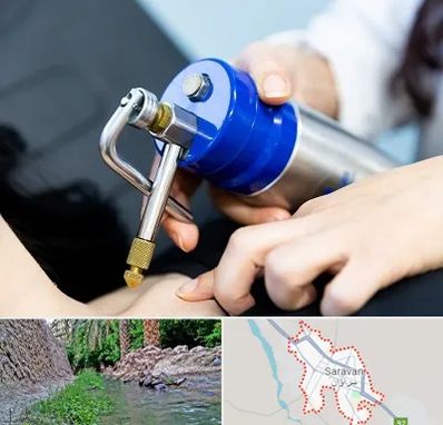 کرایوتراپی در سراوان