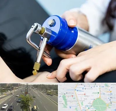 کرایوتراپی در منطقه 17 تهران 