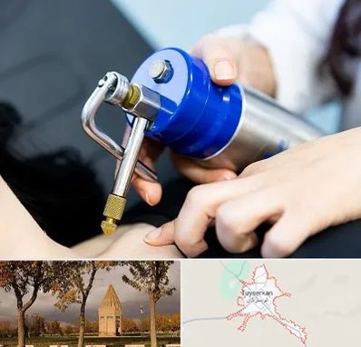کرایوتراپی در تویسرکان
