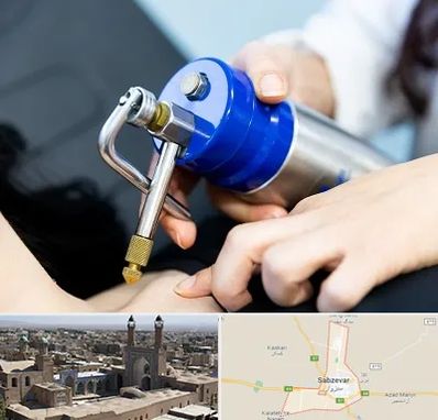 کرایوتراپی در سبزوار