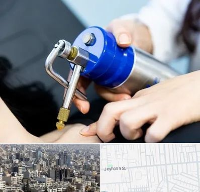 کرایوتراپی در جیحون