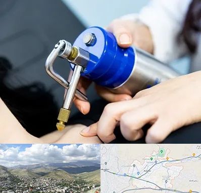 کرایوتراپی در رودهن