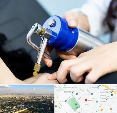 کرایوتراپی در هنگام 