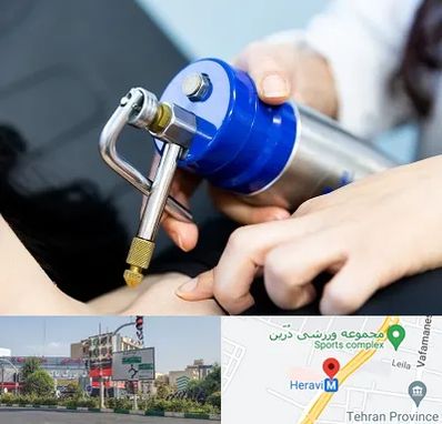 کرایوتراپی در هروی 