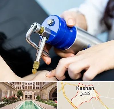 کرایوتراپی در کاشان