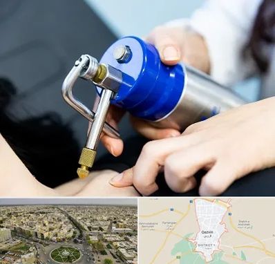 کرایوتراپی در قزوین