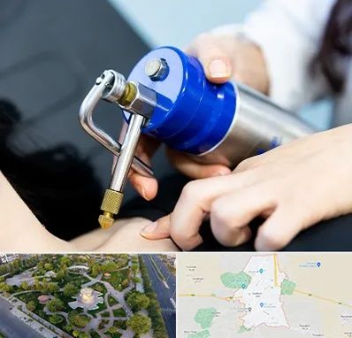 کرایوتراپی در کاشمر