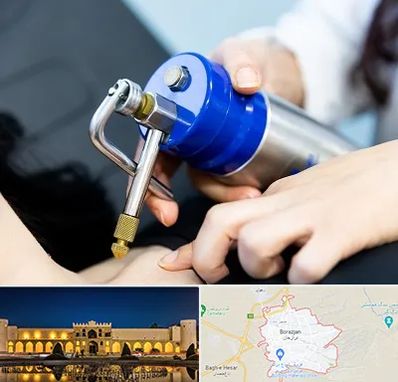 کرایوتراپی در برازجان