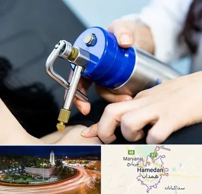 کرایوتراپی در همدان