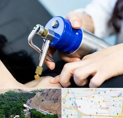 کرایوتراپی در کن 