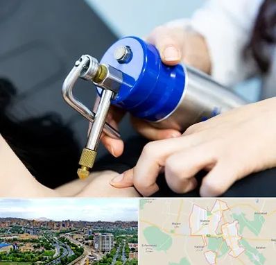 کرایوتراپی در شهریار