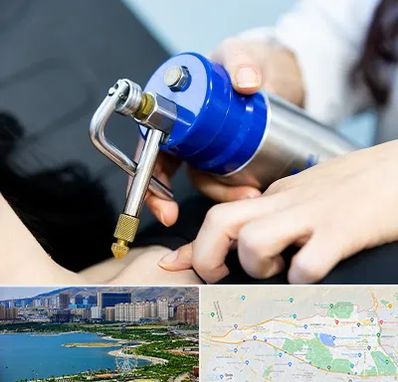 کرایوتراپی در منطقه 22 تهران 