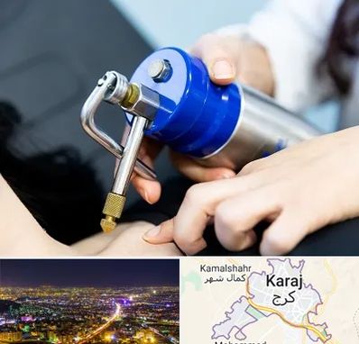 کرایوتراپی در کرج