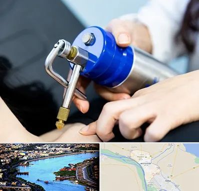 کرایوتراپی در خرمشهر