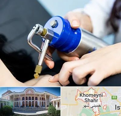 کرایوتراپی در خمینی شهر