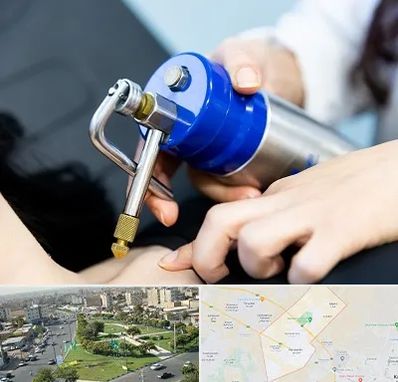 کرایوتراپی در کمال شهر کرج 