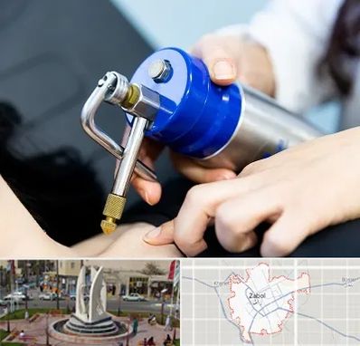 کرایوتراپی در زابل