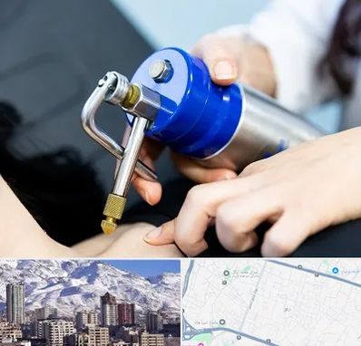 کرایوتراپی در ازگل