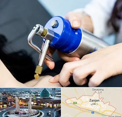 کرایوتراپی در زنجان