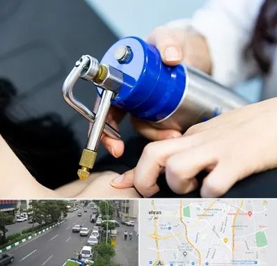 کرایوتراپی در ستارخان 