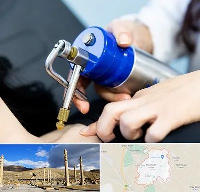 کرایوتراپی در مرودشت