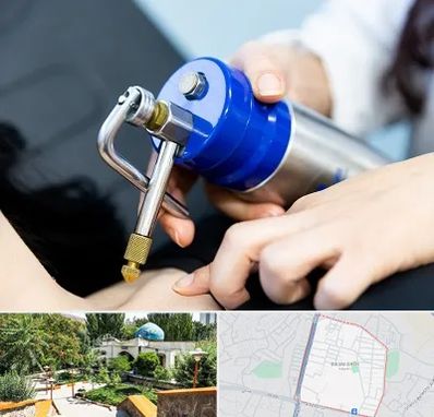 کرایوتراپی در باغمیشه تبریز