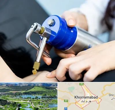 کرایوتراپی در خرم آباد