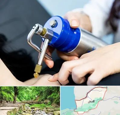 کرایوتراپی در گلستان