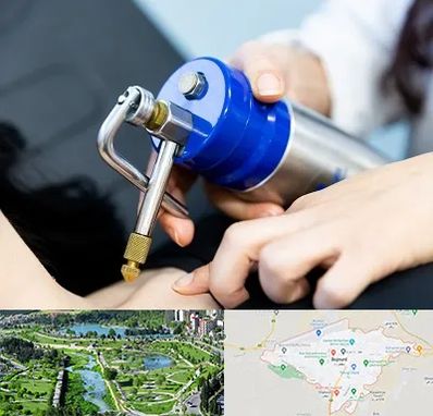 کرایوتراپی در بجنورد