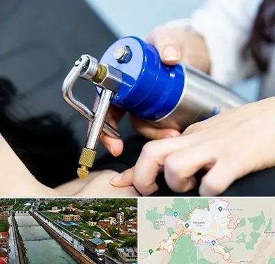 کرایوتراپی در مراغه