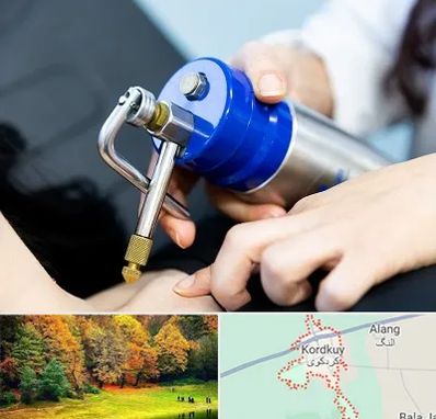 کرایوتراپی در کردکوی