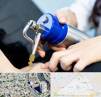 کرایوتراپی در قاسم آباد مشهد 