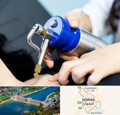 کرایوتراپی در اصفهان