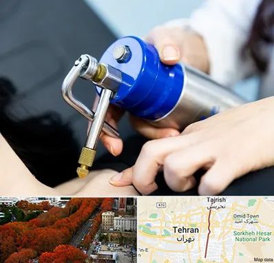 کرایوتراپی در ولیعصر 