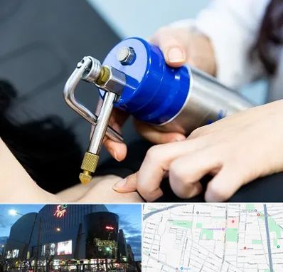 کرایوتراپی در بلوار اباذر