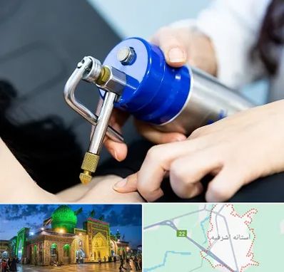 کرایوتراپی در آستانه اشرفیه