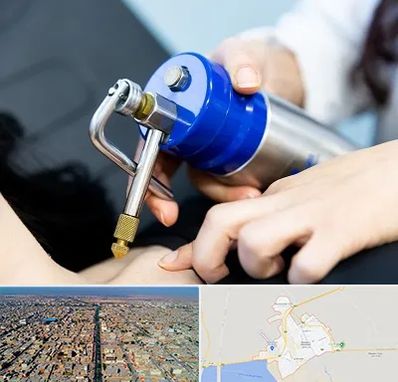 کرایوتراپی در بندر ماهشهر