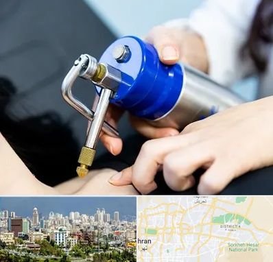 کرایوتراپی در شرق تهران 