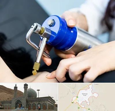 کرایوتراپی در شهرضا