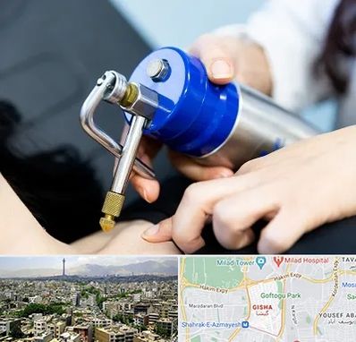 کرایوتراپی در گیشا 