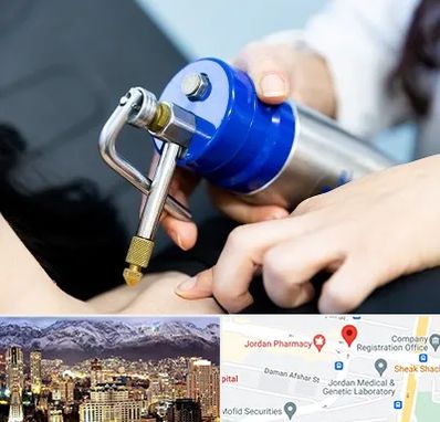 کرایوتراپی در جردن 