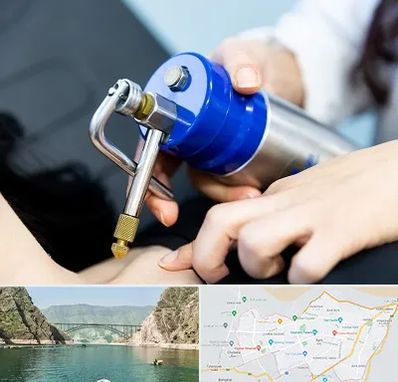 کرایوتراپی در ایلام