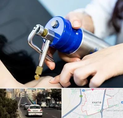 کرایوتراپی در خطیب تبریز